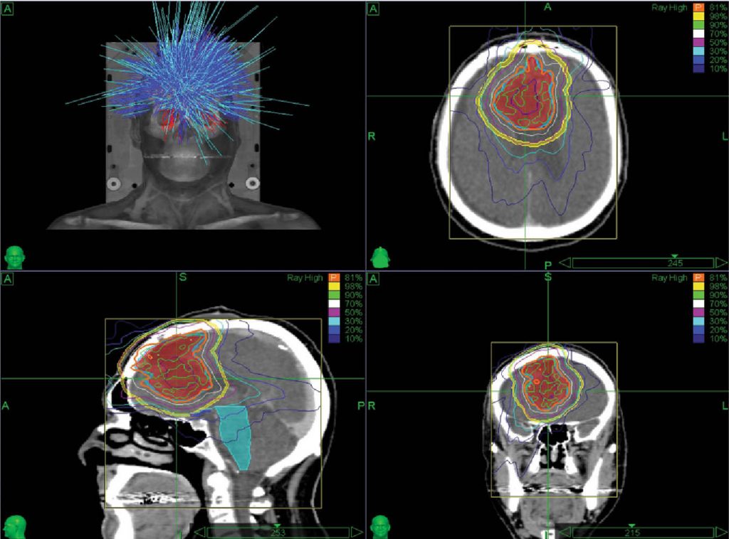 ck (3) CyberKnife Robotic Radiosurgery at Mount Miriam Cancer Hospital
